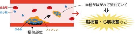No.28　血栓治療薬【図1】 